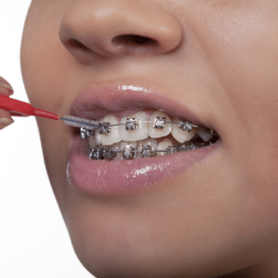 Best Tip For His Patients With Braces Modesto Ca
