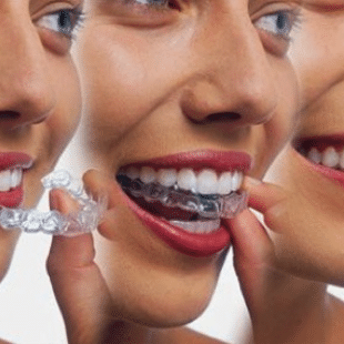 Invisalign For Adults