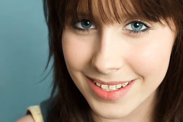 Affordable Clear Braces Provider In Modesto CA