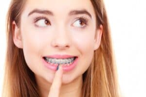 How Much Do Braces Cost In Modesto