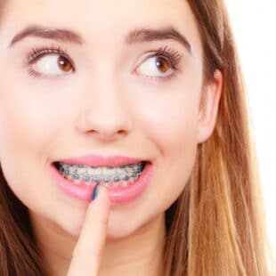 How Much Do Braces Cost In Modesto?