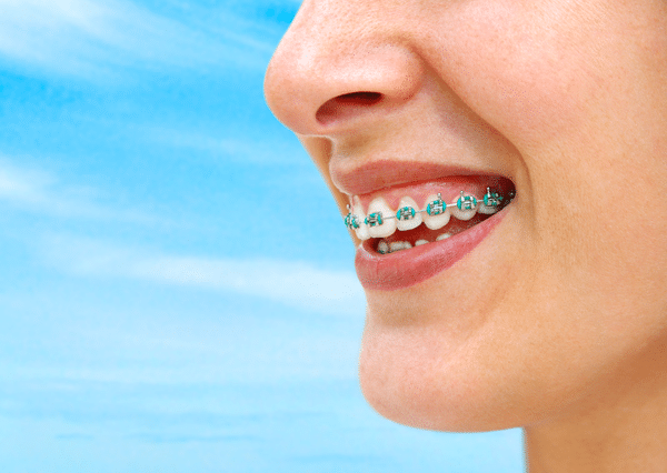 Braces Modesto CA