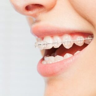 The Best Types Of Braces For Adults