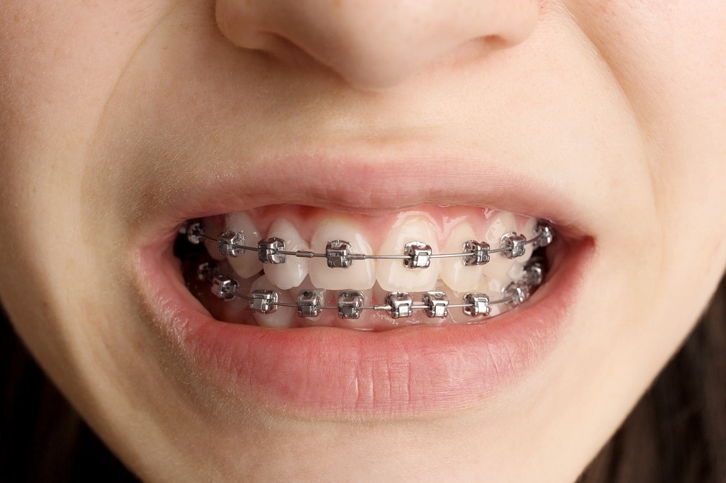How To Manage Rubber Bands and Braces Pain