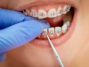 Comprehensive Guide On Braces