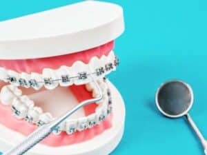 Things To Know Before Getting Braces