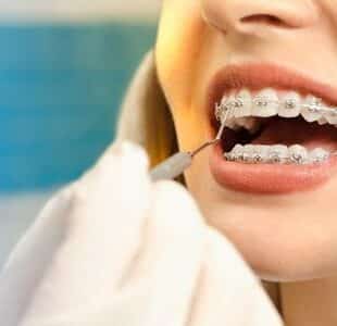 Things To Know Before Getting Braces